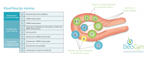Miomi na materici Šta su miomi na materici koji su simptomi lečenje